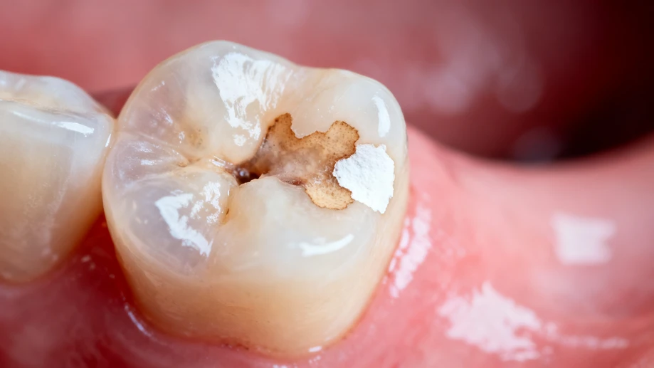 The Top 5 Secrets Your Teeth Are Hiding About Cavities (But Your Dentist Won't Tell You)